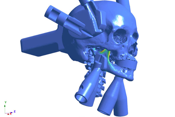 Altair SimSolid案例-骨骼生物力學研究